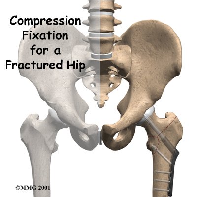 Compression Fixation for a Fractured Hip